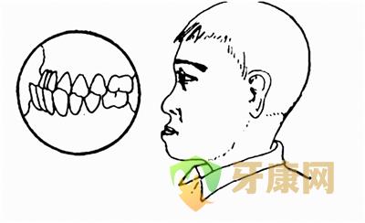 牙齿地包天有哪些危害