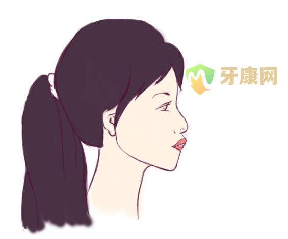 龅牙矫正后变化比较明显