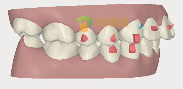 牙健网口腔医院龅牙矫正