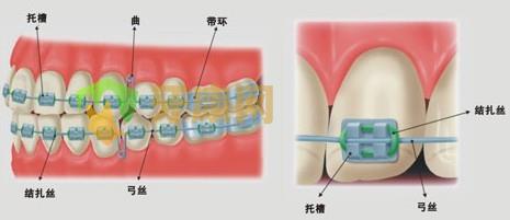 深圳牙健网金属托槽