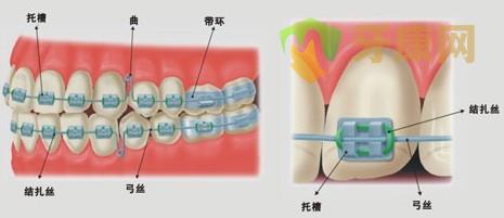 牙健网金属托槽