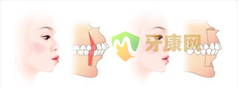 骨性龅牙和牙性龅牙**