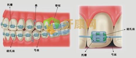 兔牙怎么进行矫正？