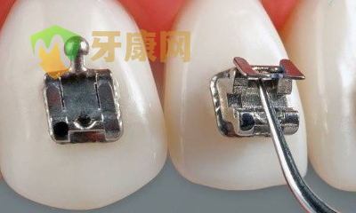 正畸