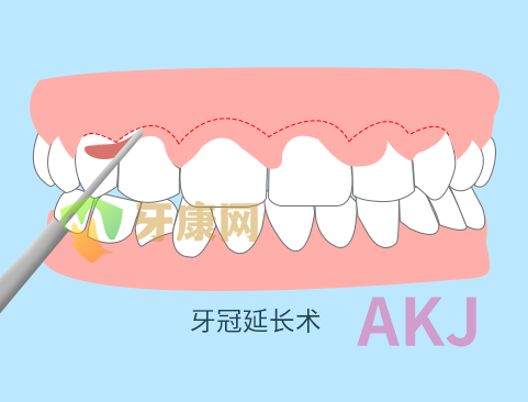 牙冠延长术