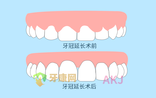 冠延长