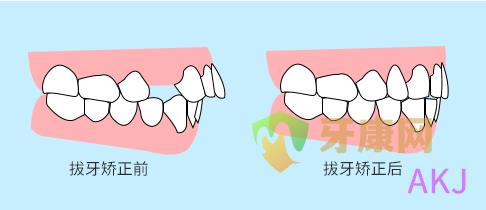 龅牙矫正