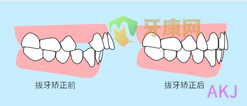 拔牙矫正