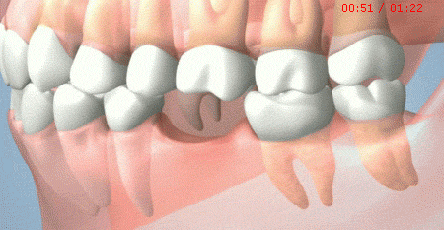 牙齿缺失修复,牙齿缺失补牙