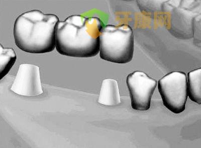 镶牙的种类,深圳镶牙,镶牙的方式有几种
