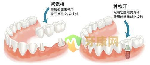 镶牙之前需要洗牙吗