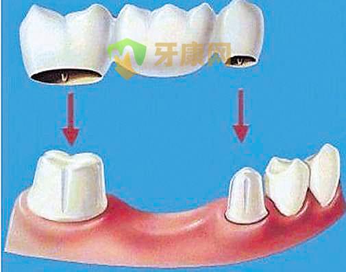 固定义齿修复的特点