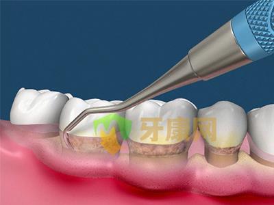 定期洁牙的重要性