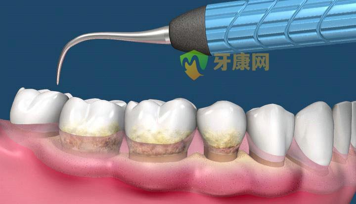清除牙结石