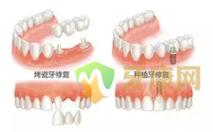 烤瓷冠
