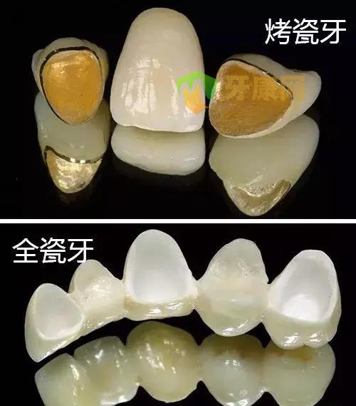 烤瓷牙