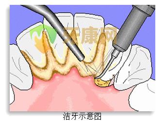 牙健网医生介绍：洗牙好不好？