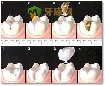 做完根管治疗后需要做嵌体修复吗？