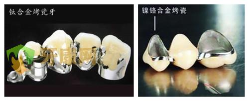 医生解析贵金属烤瓷牙的优缺点