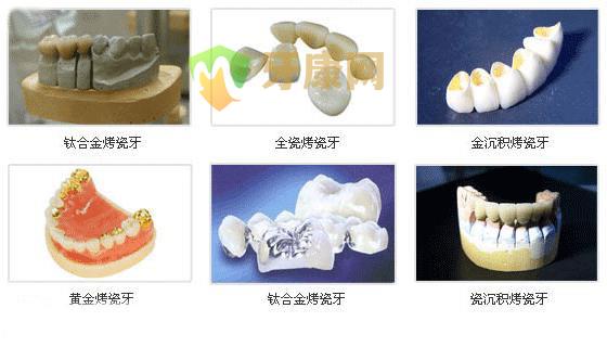 性价比高的烤瓷牙有哪些？