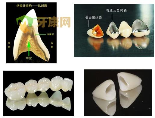 全瓷冠和烤瓷冠的材料都有哪些？