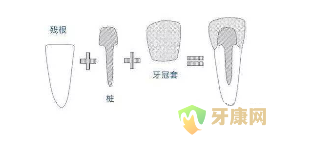 牙齿打桩和种牙差不多吗