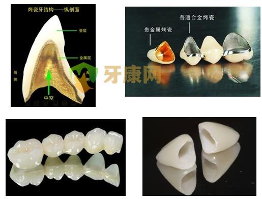 金沉积烤瓷牙多少钱？