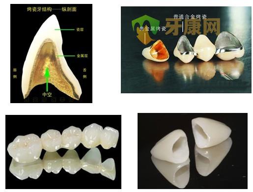 什么是金沉积烤瓷牙，优点有哪些？