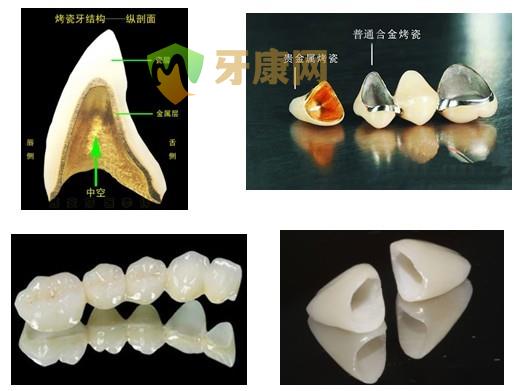 钴铬合金烤瓷牙、贵金属烤瓷牙、全瓷牙到底哪个好？