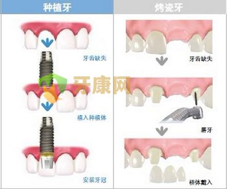 深圳镶牙多少钱？