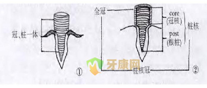 桩核冠修复的材料和优缺点介绍