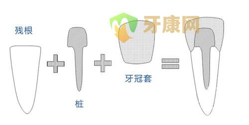 牙齿打桩做冠就是做烤瓷牙吗?