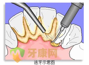 洗牙有哪些注意事项