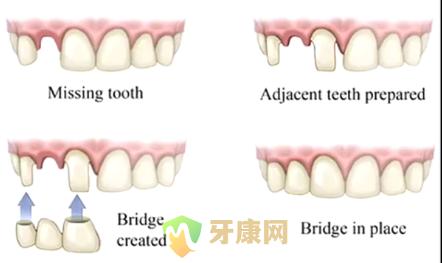 深圳牙科医院做美齿冠多少钱一颗