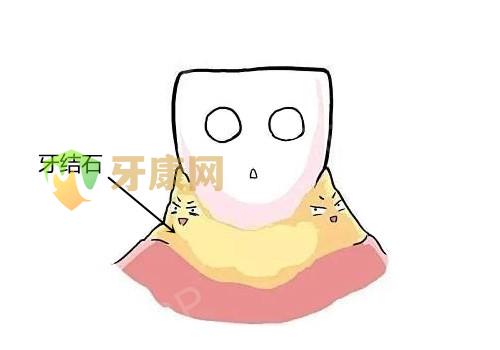 牙结石
