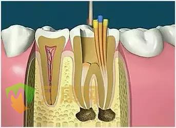 根管治疗过程
