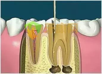 根管治疗过程
