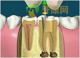 根管治疗过程