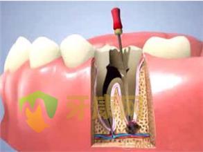 根管治疗能够治疗牙痛吗