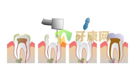 做根管治疗的过程