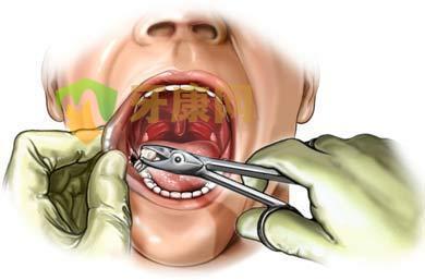 不是所有人都可以拔牙的,拔牙需知八大禁忌！