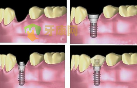 牙齿缺失种植牙