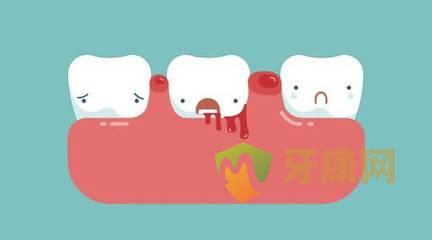 牙龈出血的治疗方法