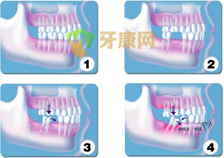 牙齿缺失怎么办