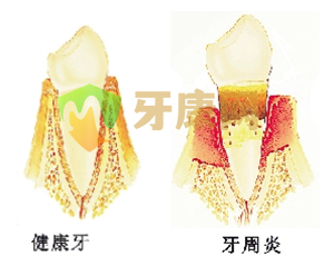 牙周炎的治疗