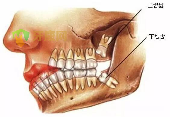 智齿怎么办