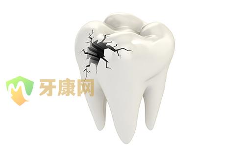 补牙后牙疼