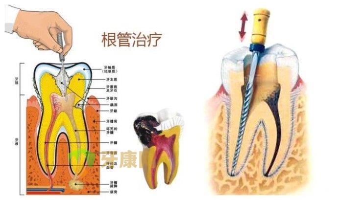 根管治疗后牙齿能用多久