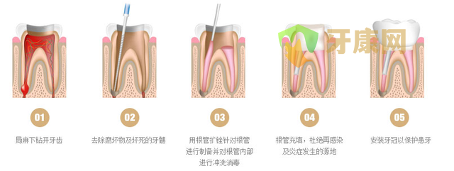乳牙根管治疗有危害吗