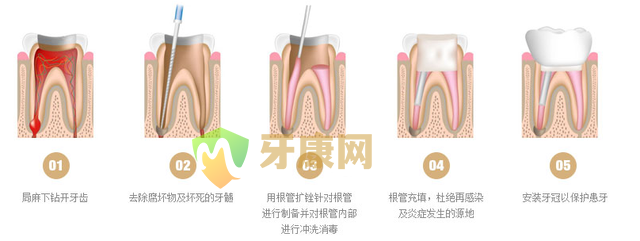 根管治疗的价格